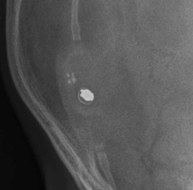 Medtronic Strata csf shunt valve x-ray