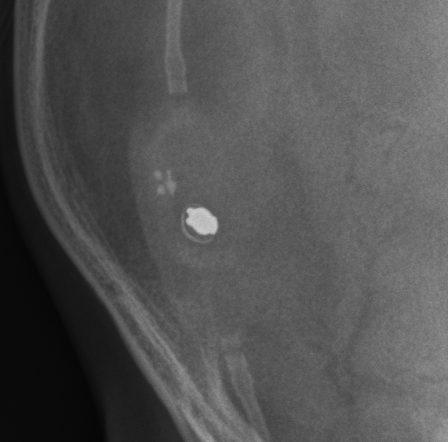 Csf Shunt Valves X Ray Appearance And Documents