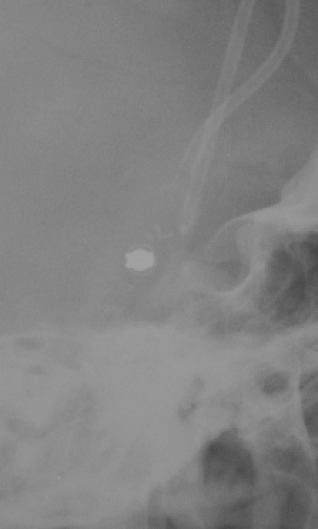 Medtronic Strata NSC csf shunt valve x-ray