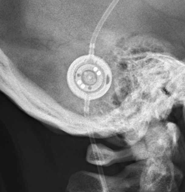 Miethke proGAV 2 csf shunt valve x-ray