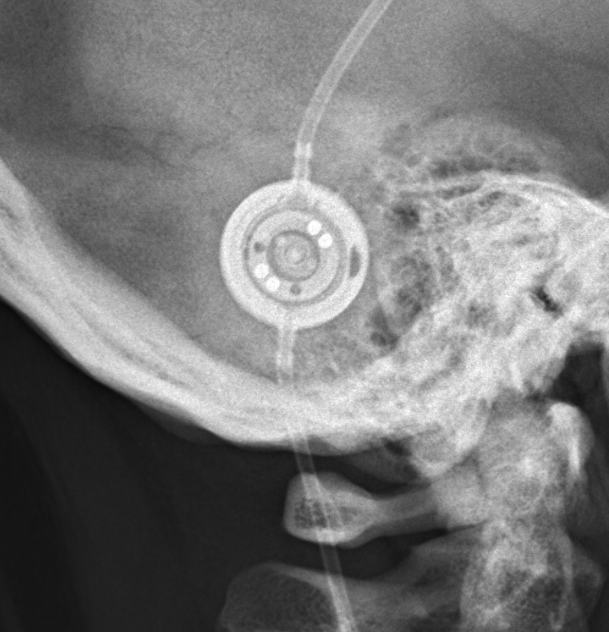 Csf Shunt Valves X Ray Appearance And Documents