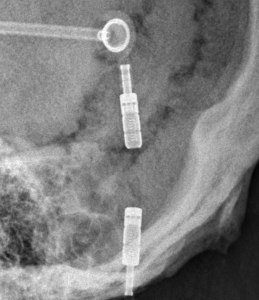 Spitz-Holter csf shunt valve x-ray